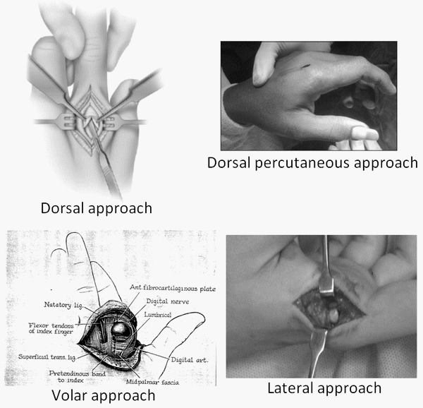 kaplan lesion approach