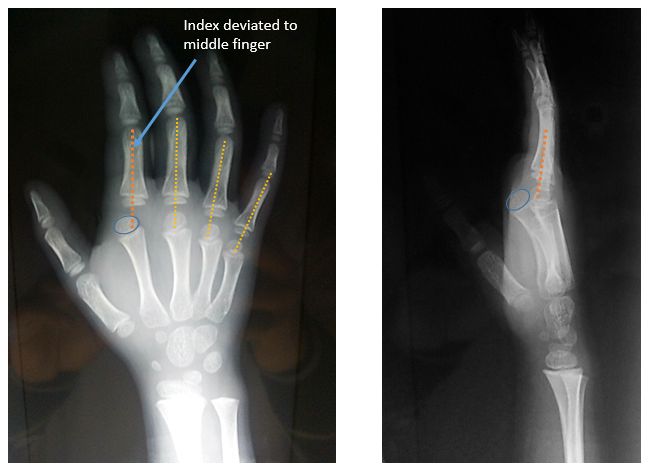 kaplan lesion xray