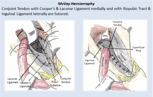 Hernia - Inguinal Hernia | Epomedicine