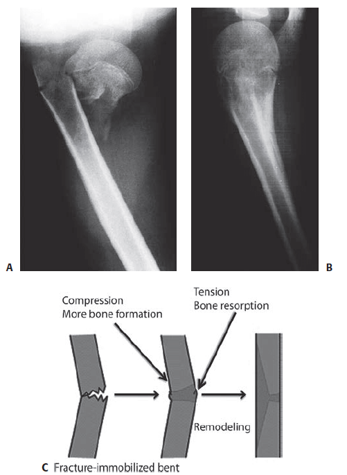 pediatric fracture remodelling