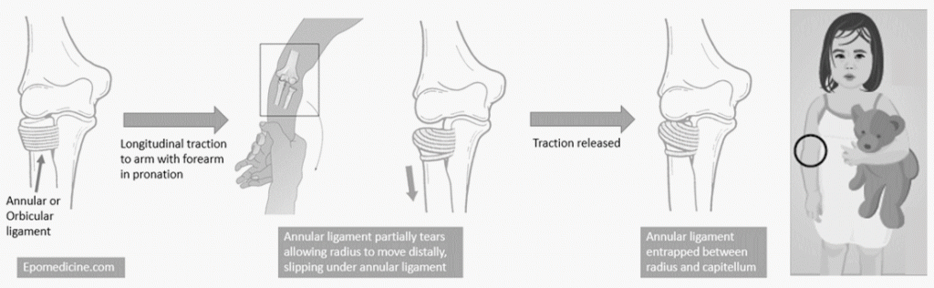 pulled elbow pathoanatomy