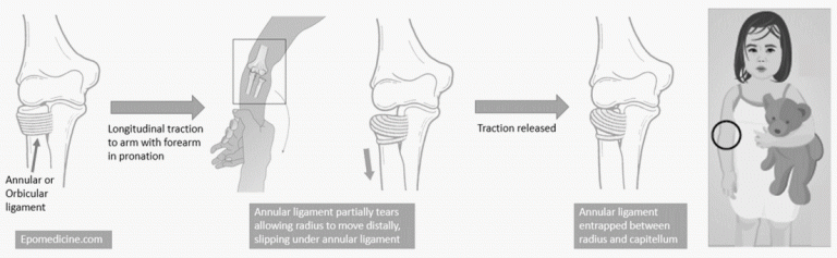 pulled-elbow-reduction-epomedicine