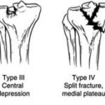 Salter Harris Classification For Physeal Fracture: Mnemonic 