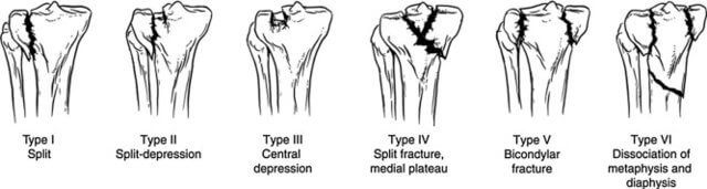 Schatzker classification of tibial plateau fracture