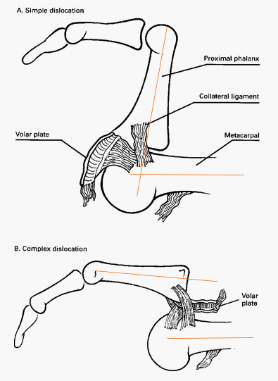 Xray Showing Closed Volar Dislocation Of The Mcpj Of The X-ray of ...