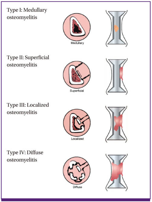 Definitions Criteria and Classifications in Osteomyelitis