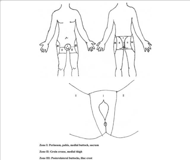 faringer classification