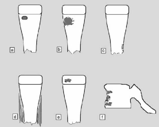 Definitions Criteria and Classifications in Osteomyelitis