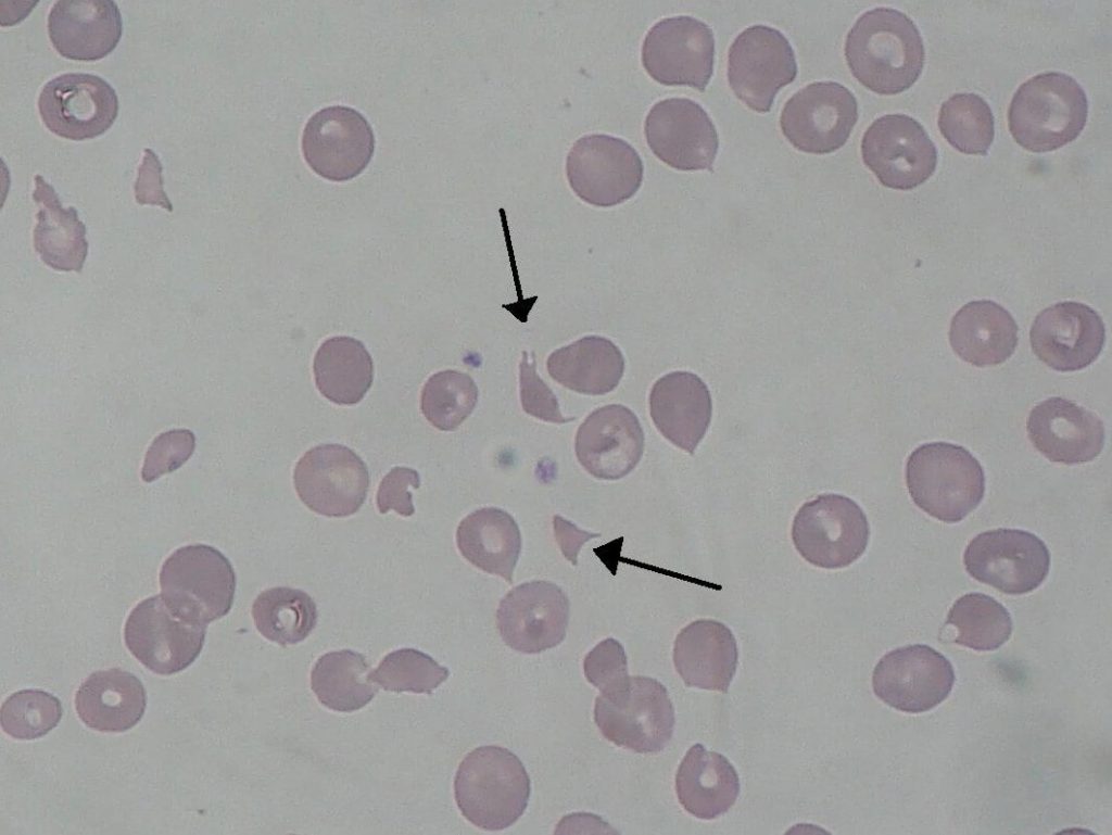 HUS schistocytes