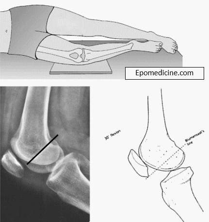 sulcus terminalis lateral femoral condyle