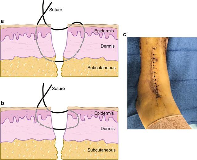 suture