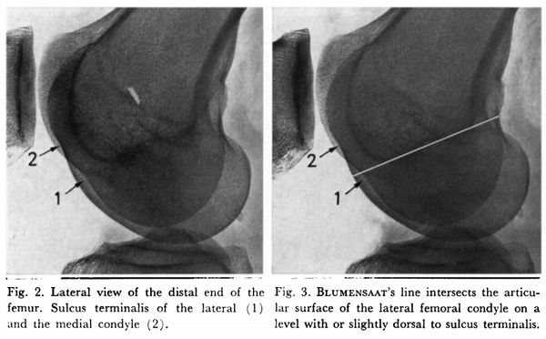 lateral femoral condyle sulcus