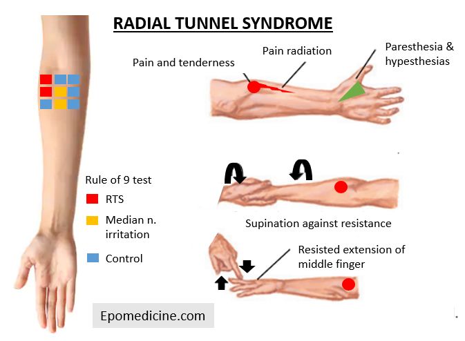 Radial tunnel syndrome