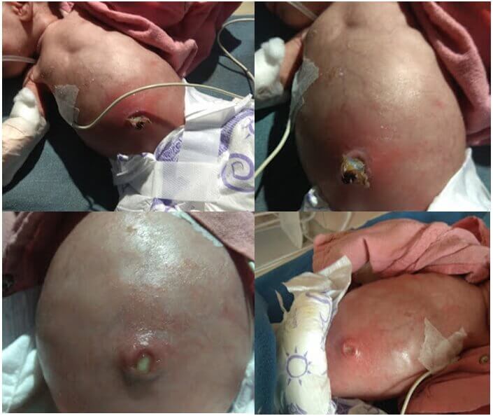 umbilical infection neonate shock