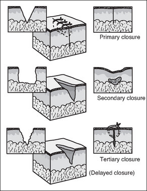 Wound healing and closure