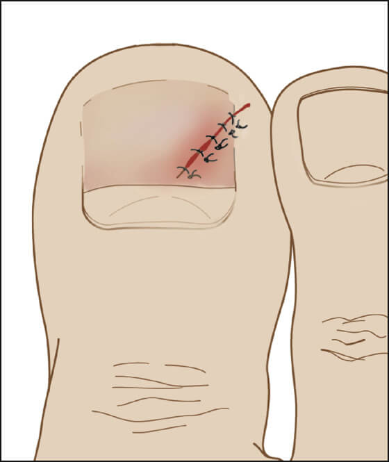 Nail Bed Injuries Treatment | Sydney Orthopaedic Surgeon