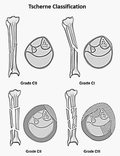 tscherne classification closed fractures