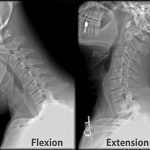 X Ray Of Mastoids Epomedicine