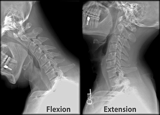 Cervical spine alignment, Radiology Reference Article