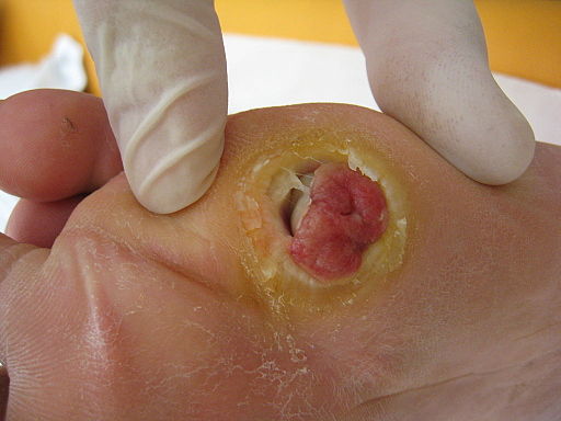 diabetic foot