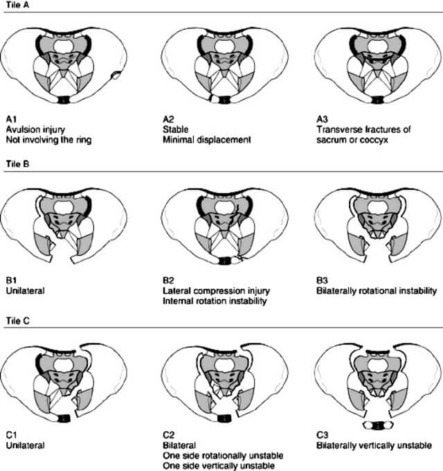 Types of Pelvis Fractures