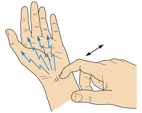 Tinel Sign Epomedicine