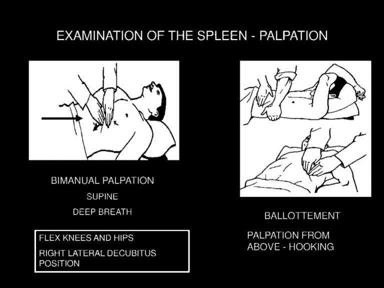 splenomegaly-examination-techniques-and-clinical-approach-epomedicine