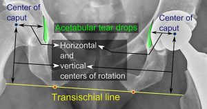 Causes of Dislocation of Total Hip Arthroplasty : WHAT mnemonic ...