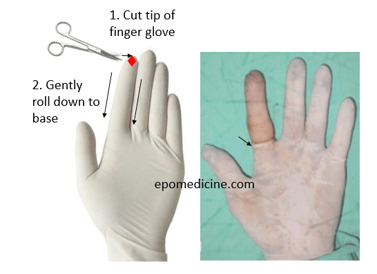 How to make tourniquet for fingers using latex gloves?