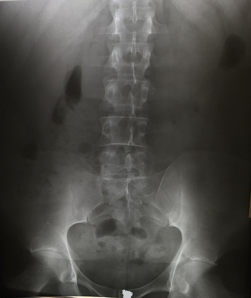 Thoracic spine x-ray