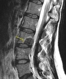 Thoracolumbar Metastases Management : Mnemonic Approach | Epomedicine