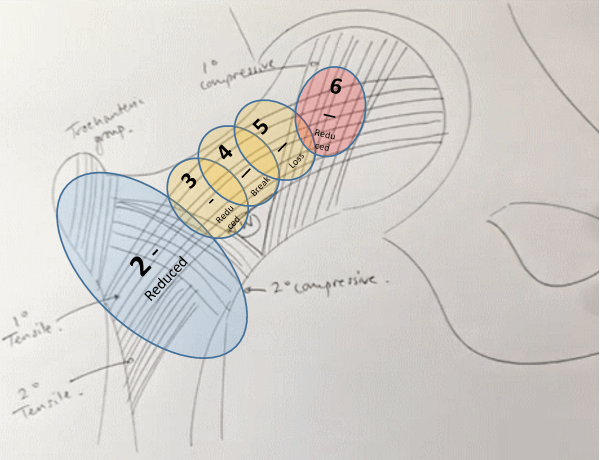 Singh Index for Osteoporosis - Simplified | Epomedicine