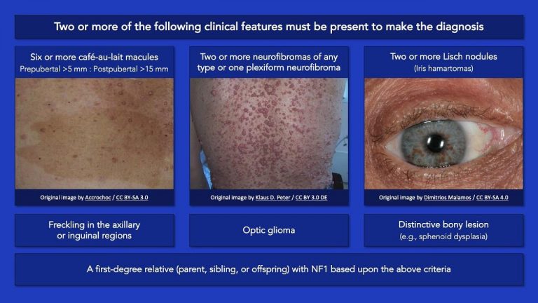 Neurofibromatosis type 1 Criteria : Mnemonic | Epomedicine