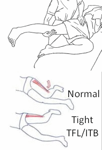 Ober Test Overview  Iliotibial Band Tightness