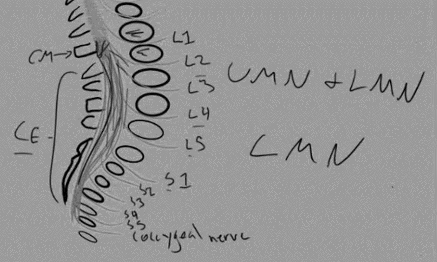 conus medullaris syndrome vs cauda equina syndrome