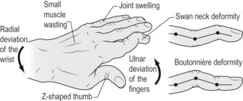 rheumatoid hand
