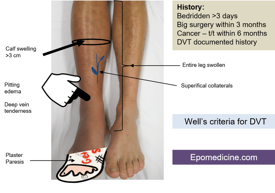 Two Level Dvt Wells Score Download Scientific Diagram