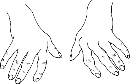 rheumatoid hand