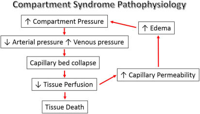 Pathophysiology of Acute Compartment syndrome