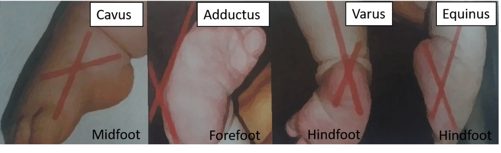 ctev deformities