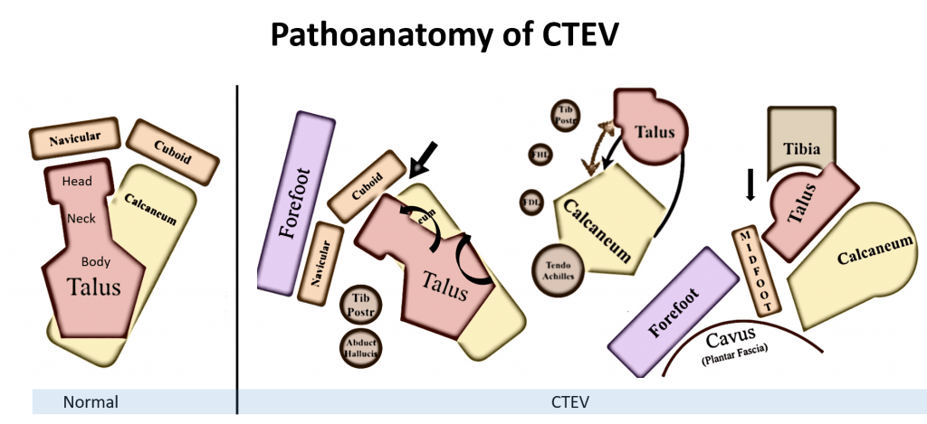 CTEV pathoanatomy bony changes