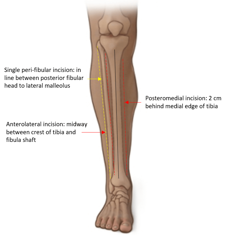 leg fasciotomy incisions