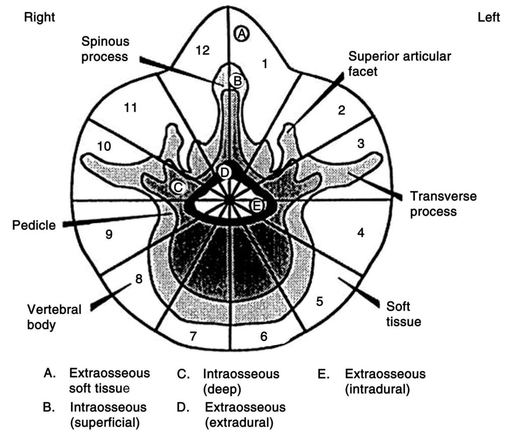 wbb spinal tumor