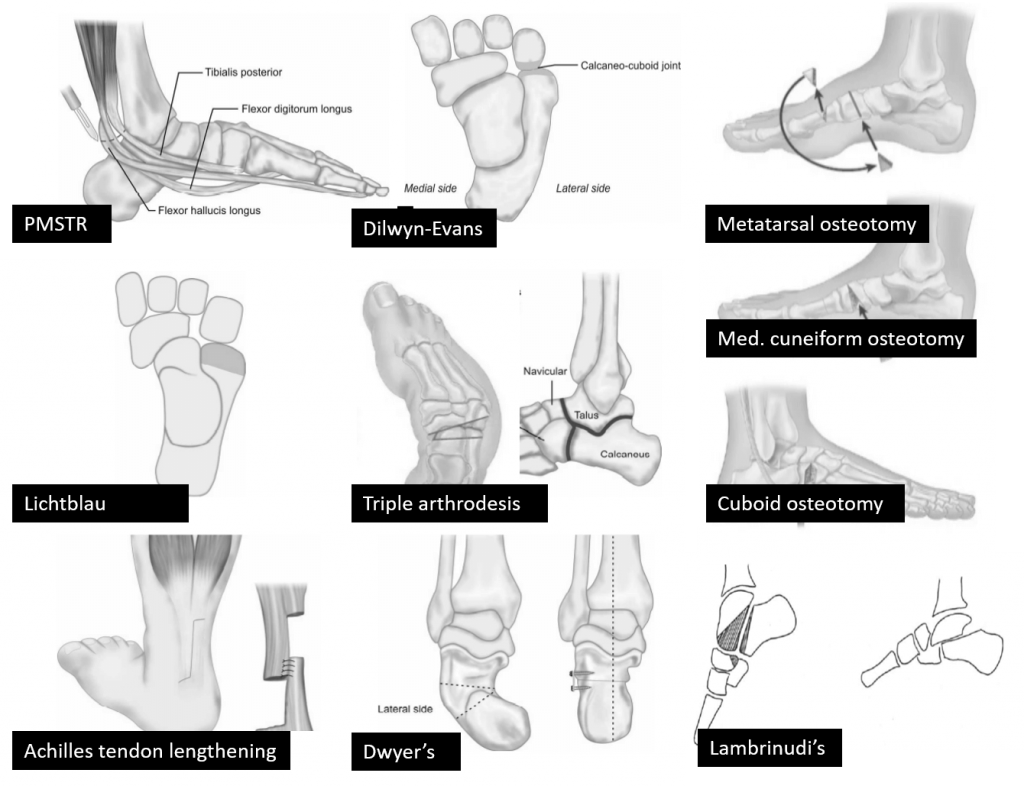 CTEV surgeries