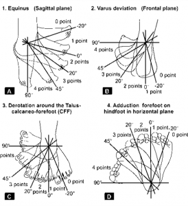 Pirani Score and Dimeglio Classification for Clubfoot Assessment ...