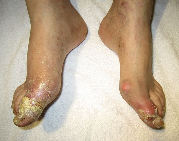 tophaceous gout