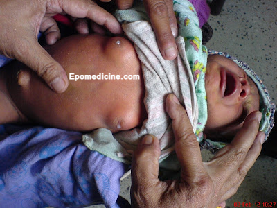 Breast Engorgement in Newborns Galactorrhea or Witch s Milk