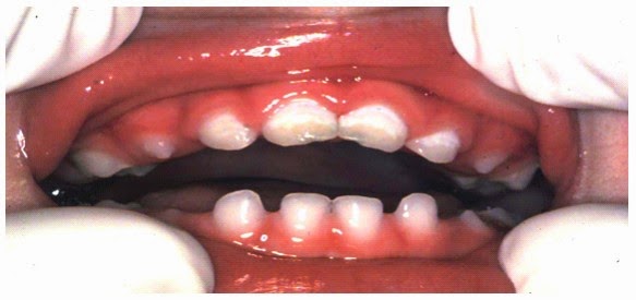 tooth decay initial stage