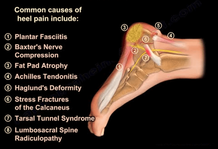 heel pain causes