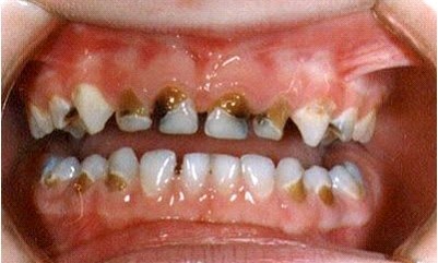 tooth decay 3rd stage